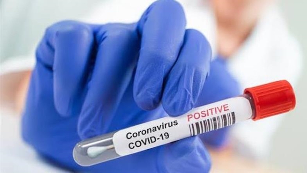 Coronavirus COVID 19 positive
