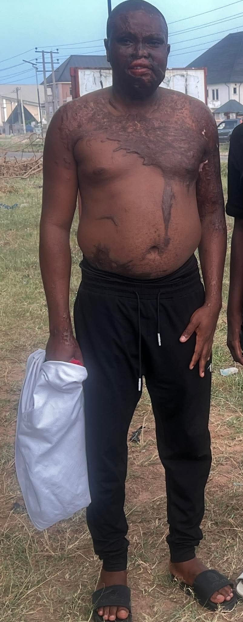 Nigerian man pours acid on his elder brother